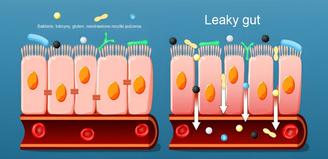 Zespół nieszczelnego jelita zeolit zespół jelita drażliwego